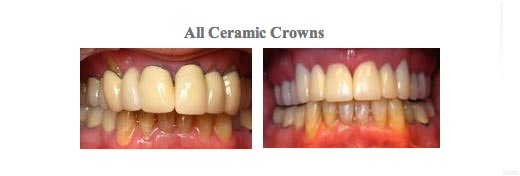 Before and After images of Dental Crowns from {PRACTICE_NAME}