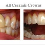 Before and After photos of Dental Crowns from {PRACTICE_NAME}