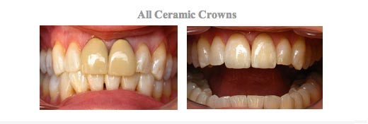 Before and After photos of Dental Crowns from {PRACTICE_NAME}