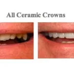 Before and After pictures of Dental Crowns from {PRACTICE_NAME}
