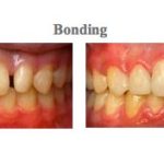 Before and After pictures of dental bonding from {PRACTICE_NAME}