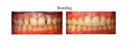 Before and After pictures of dental bonding from {PRACTICE_NAME}