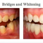 Before and After pictures of teeth whitening and dental bridges from {PRACTICE_NAME}
