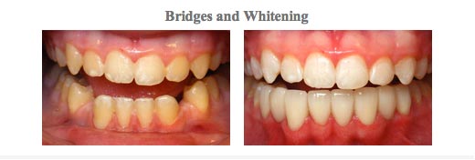 Before and After pictures of teeth whitening and dental bridges from {PRACTICE_NAME}