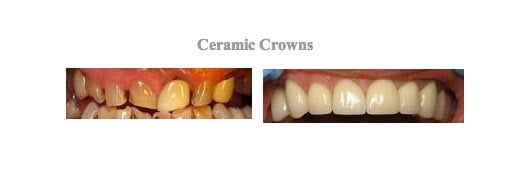 Images before and after treatment at {PRACTICE_NAME} for dental crowns