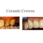 Images before and after treatment at {PRACTICE_NAME} for dental crowns