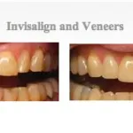 Images before and after treatment at {PRACTICE_NAME} for invisalign clear braces and veneers
