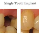 Photos before and after treatment at {PRACTICE_NAME} for a single tooth implant