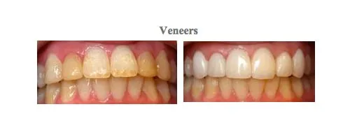 Photos before and after treatment at {PRACTICE_NAME} for dental veneers