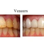 Photos before and after treatment at {PRACTICE_NAME} for dental veneers