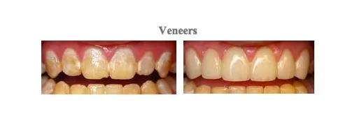 Pictures before and after treatment at {PRACTICE_NAME} for dental veneers