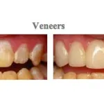Pictures before and after treatment at {PRACTICE_NAME} for dental veneers