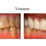 Images before and after treatment at {PRACTICE_NAME} for dental veneers
