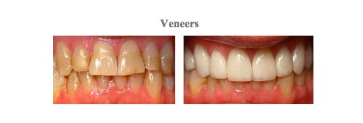 Images before and after treatment at {PRACTICE_NAME} for dental veneers