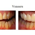 Before and after of photos for dental veneers at {PRACTICE_NAME}