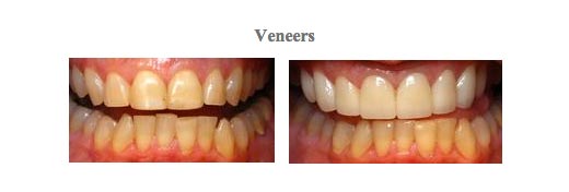 Before and after of photos for dental veneers at {PRACTICE_NAME}