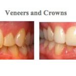 Before and after of photos for dental veneers and dental crowns at {PRACTICE_NAME}