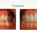 Before and after of pictures for dental veneers at {PRACTICE_NAME}