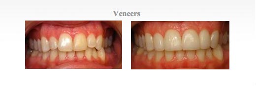 Before and after of pictures for dental veneers at {PRACTICE_NAME}